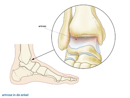Artrose de enkel Orthopedisch Vechtdal