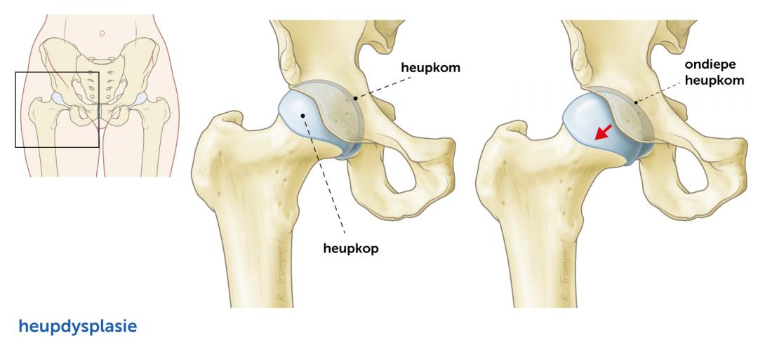 pijn in heup bij opstaan uit stoel